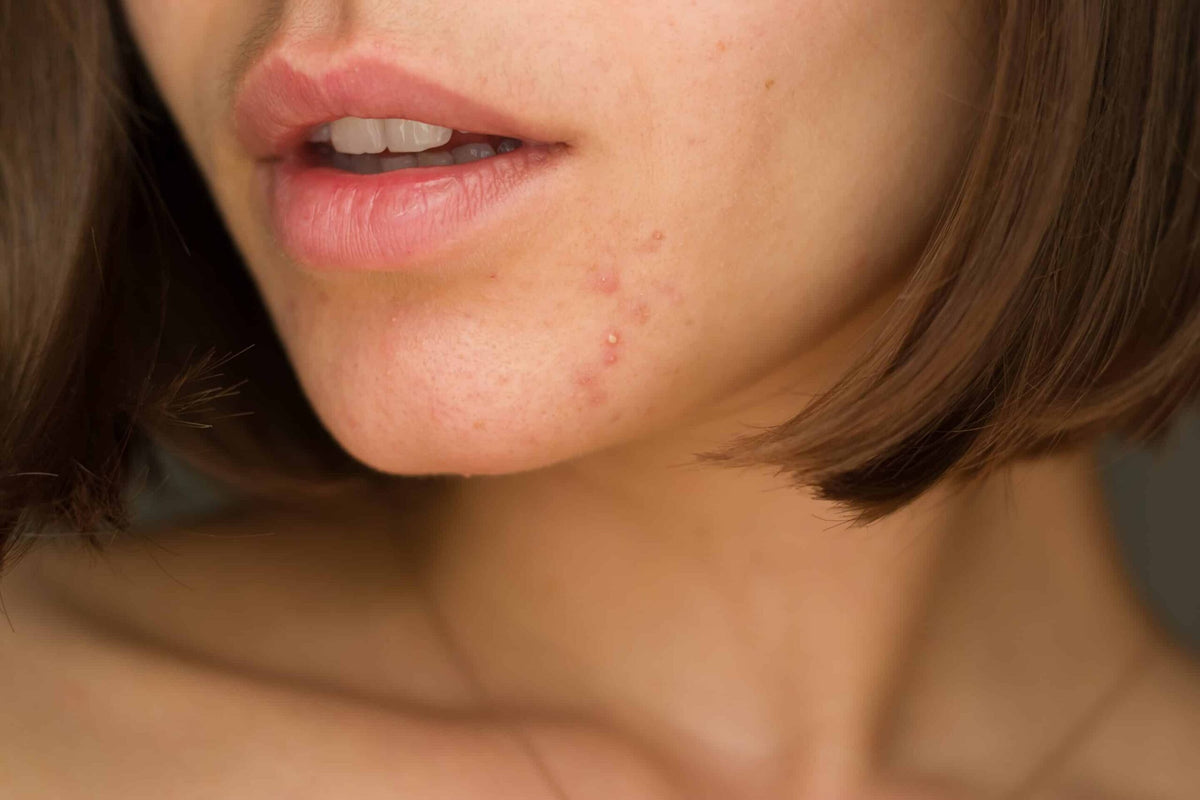 Quel est le rôle des hormones dans les imperfections hormonales cutanée ?