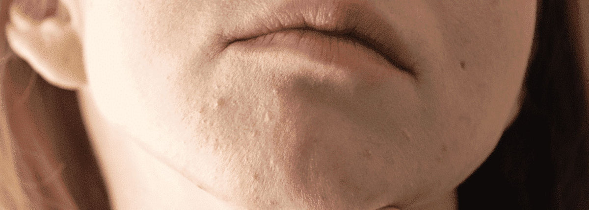 Imperfections hormonales